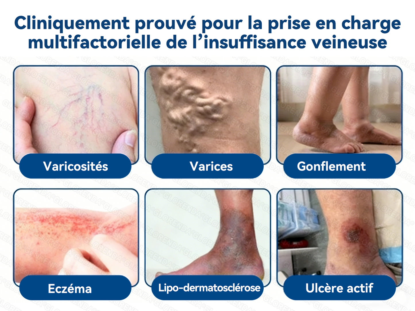 𝐆𝑳𝑶𝗥𝙀𝙉𝐃𝑨®𝐏𝐚𝒕𝒄𝗵 𝗠𝙞𝙘𝙧𝙤𝙣𝙚𝐞𝐝𝐥𝒆 𝑪𝒐𝒏𝘁𝗼𝙪𝙧 𝙙𝐞𝐬 𝐕𝐞𝒊𝒏𝒆𝘀 𝗮𝘃𝙚𝙘 𝙇𝙞𝙫𝐫𝐚𝐢𝐬𝒐𝒏 𝑨𝒗𝒂𝗻𝗰é𝙚 𝙙𝙚 𝘿𝙞𝐨𝐬𝐦𝐢𝒏𝒆 & 𝑯𝗲𝘀𝗽é𝗿𝙞𝙙𝙞𝙣𝙚🌿 𝐑é𝐬𝐮𝐥𝐭𝐚𝐭𝐬 𝐕𝐢𝐬𝐢𝐛𝐥𝐞𝐬 𝐞𝐧 𝟕 𝐉𝐨𝐮𝐫𝐬 — 𝐌é𝐥𝐚𝐧𝐠𝐞 𝐇𝐞𝐫𝐛𝐨𝐫𝐢𝐬𝐭𝐞 𝐀𝐯𝐚𝐧𝐜é 𝐂𝐢𝐛𝐥𝐞 𝐥𝐞𝐬 𝐕𝐞𝐢𝐧𝐞𝐬 𝐓é𝐥𝐚𝐧𝐠𝐢𝐞𝐜𝐭𝐚𝐭𝐢𝐪𝐮𝐞𝐬 𝐞𝐭 𝐒𝐨𝐮𝐥𝐚𝐠𝐞 𝐥𝐞𝐬 𝐉𝐚𝐦𝐛𝐞𝐬 𝐋𝐨𝐮𝐫𝐝𝐞𝐬 𝐞𝐭 𝐅𝐚𝐭𝐢𝐠𝐮é𝐞𝐬