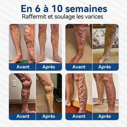 𝐆𝑳𝑶𝗥𝙀𝙉𝐃𝑨®𝐏𝐚𝒕𝒄𝗵 𝗠𝙞𝙘𝙧𝙤𝙣𝙚𝐞𝐝𝐥𝒆 𝑪𝒐𝒏𝘁𝗼𝙪𝙧 𝙙𝐞𝐬 𝐕𝐞𝒊𝒏𝒆𝘀 𝗮𝘃𝙚𝙘 𝙇𝙞𝙫𝐫𝐚𝐢𝐬𝒐𝒏 𝑨𝒗𝒂𝗻𝗰é𝙚 𝙙𝙚 𝘿𝙞𝐨𝐬𝐦𝐢𝒏𝒆 & 𝑯𝗲𝘀𝗽é𝗿𝙞𝙙𝙞𝙣𝙚💃 𝐑é𝐬𝐮𝐥𝐭𝐚𝐭𝐬 𝐕𝐢𝐬𝐢𝐛𝐥𝐞𝐬 𝐞𝐧 𝟕 𝐉𝐨𝐮𝐫𝐬 — 𝐌é𝐥𝐚𝐧𝐠𝐞 𝐇𝐞𝐫𝐛𝐨𝐫𝐢𝐬𝐭𝐞 𝐀𝐯𝐚𝐧𝐜é 𝐂𝐢𝐛𝐥𝐞 𝐥𝐞𝐬 𝐕𝐞𝐢𝐧𝐞𝐬 𝐓é𝐥𝐚𝐧𝐠𝐢𝐞𝐜𝐭𝐚𝐭𝐢𝐪𝐮𝐞𝐬 𝐞𝐭 𝐒𝐨𝐮𝐥𝐚𝐠𝐞 𝐥𝐞𝐬 𝐉𝐚𝐦𝐛𝐞𝐬 𝐋𝐨𝐮𝐫𝐝𝐞𝐬 𝐞𝐭 𝐅𝐚𝐭𝐢𝐠𝐮é𝐞𝐬